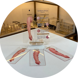 01 lipedema braco tipo iv quadro de marcacao macromodelo